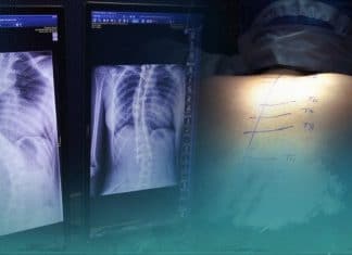 Nicaragua, primer país en realizar cirugías de escoliosis gratis