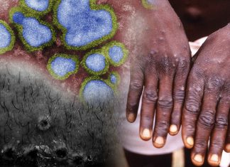 ¿Cómo se transmite la Viruela del Mono? ¿Cómo se transmite la Viruela del Mono?