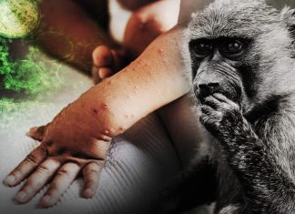 ¿Qué es la viruela del mono y cuáles son sus síntomas? Viruela del mono