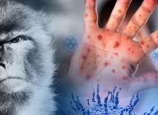 Científicos advierten que la Viruela del Mono ha evolucionado aceleradamente