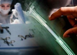 ¿Por qué las cirugías para aumentar altura se encuentran en auge?