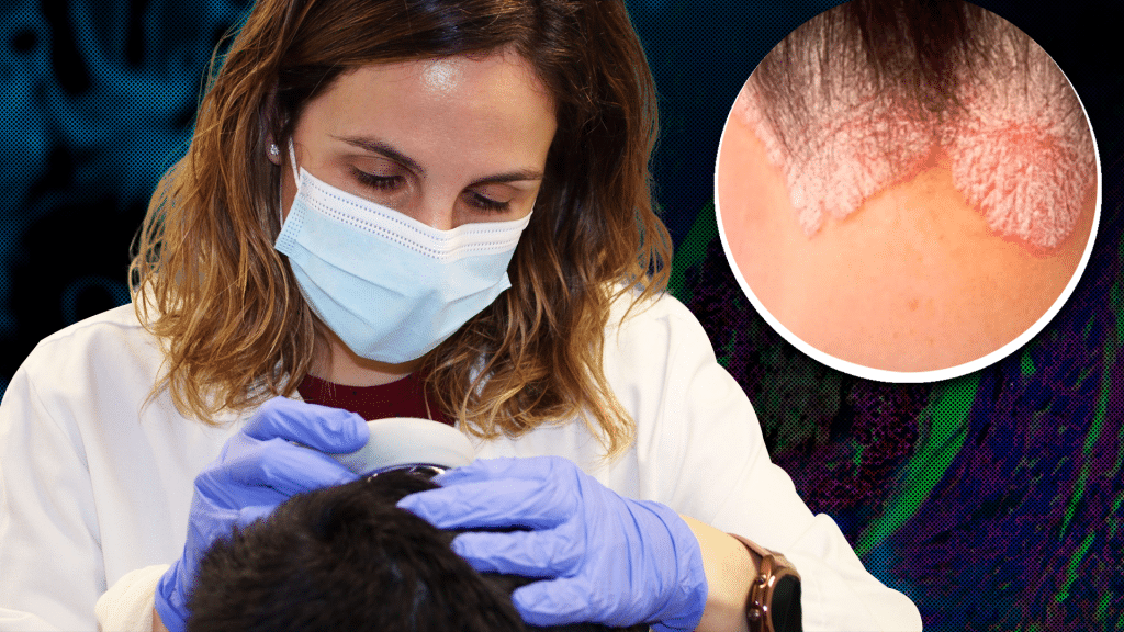 Cases of ringworm infection reported in New York City