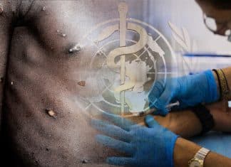 Monkeypox is no longer a global health emergency Monkeypox is no longer a global health emergency