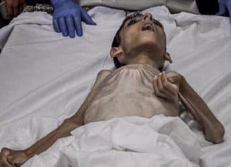 Niños palestinos mueren por desnutrición en Gaza, ante bloqueo impuesto por Israel Bloqueo impuesto por Israel contra Gaza, provoca la muerte por desnutrición de niños palestinos.