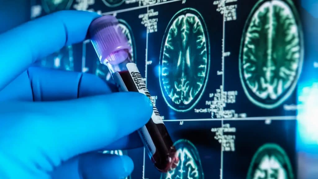 Detección del Alzheimer más fácil y precisa con nueva prueba de sangre.