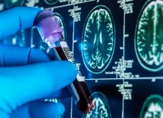 Nuevos análisis de sangre podrían facilitar la detección del alzhéimer Detección del Alzheimer más fácil y precisa con nueva prueba de sangre.