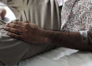 ¿Qué tan letal es la nueva cepa de la viruela del mono? Resurgimiento de la viruela del mono en África.