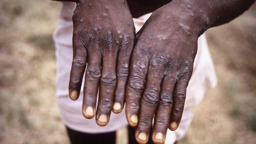 Sudáfrica en alerta máxima por viruela del mono