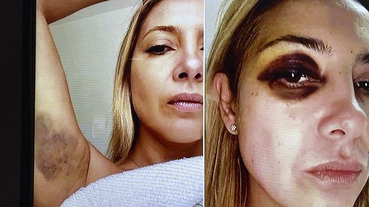 Imágenes de Fabiola Yañez, presuntamente agredida por Alberto Fernández, muestran un ojo morado y moretones en su axila.