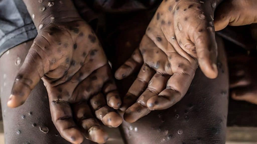 Organización Mundial de la Salud advierte sobre peligrosa escalada de casos de mpox.