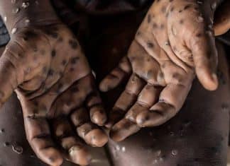 OMS mantiene alerta mundial por aumento de mpox Organización Mundial de la Salud advierte sobre peligrosa escalada de casos de mpox.