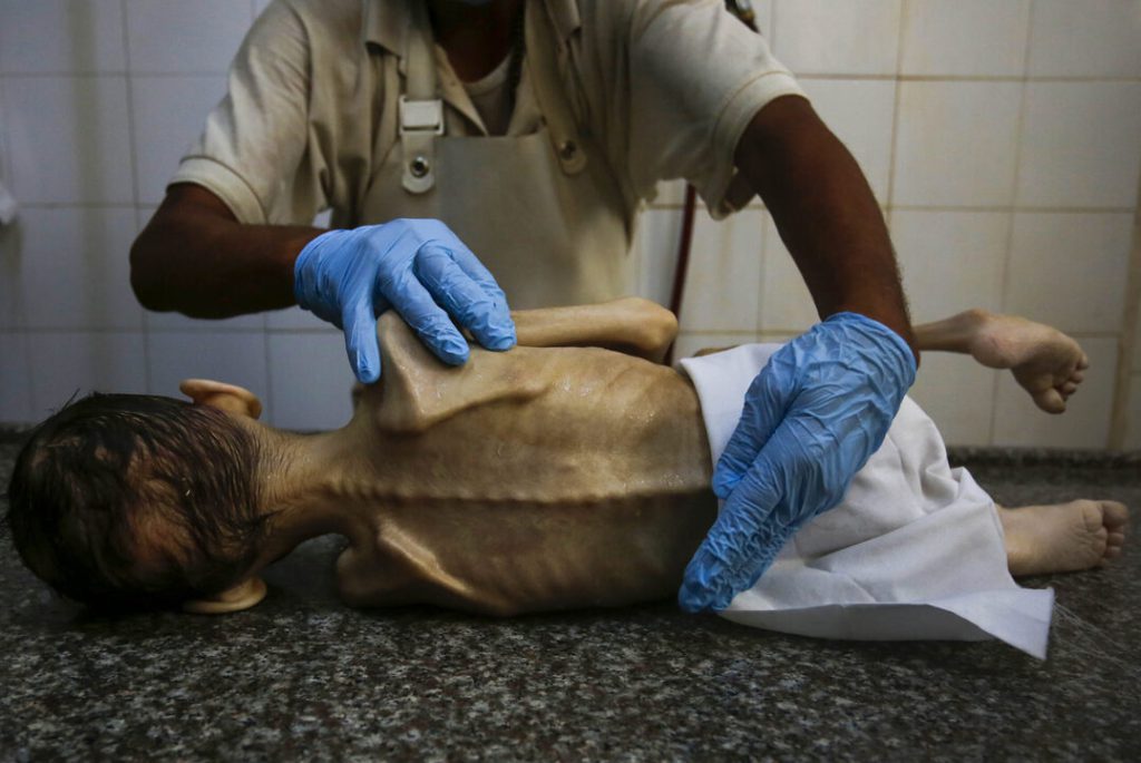 Gaza registra el doble de casos de desnutrición infantil aguda 