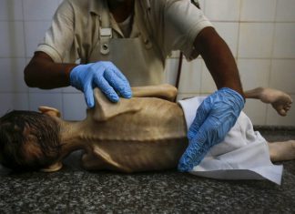 OMS: 12 mil niños padecen desnutrición aguda en Gaza Gaza registra el doble de casos de desnutrición infantil aguda
