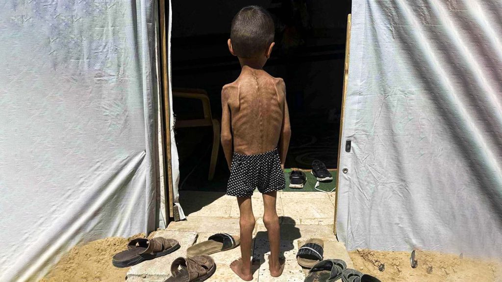 Unicef denuncia niveles críticos de desnutrición infantil en Gaza