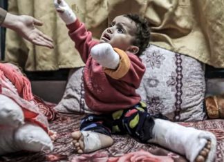 Genocidio israelí deja más de 6000 personas amputadas en Gaza